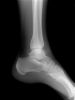 X ray shows soft tissue damage injury after accident