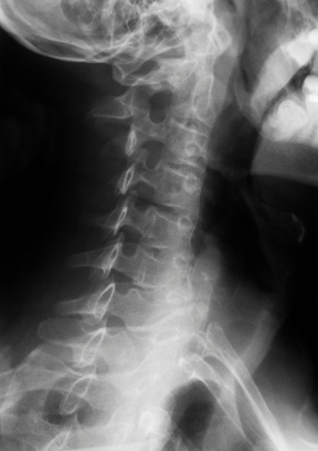 The neck X-ray confirms a whiplash injury, highlighting the importance of consulting a Florida PI lawyer.